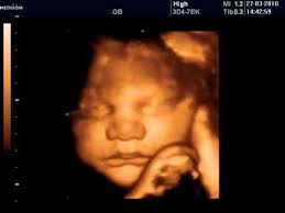 3D/4D Scan - Between 26 - 32 Weeks  (Twins)